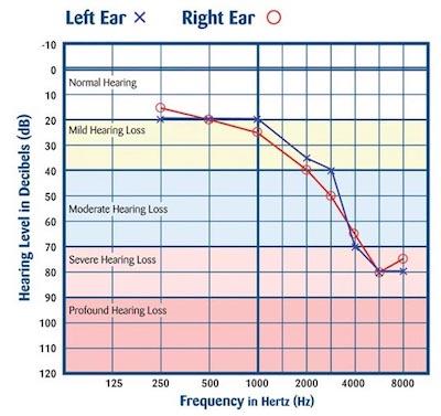 Hearing Levels in Decibels
